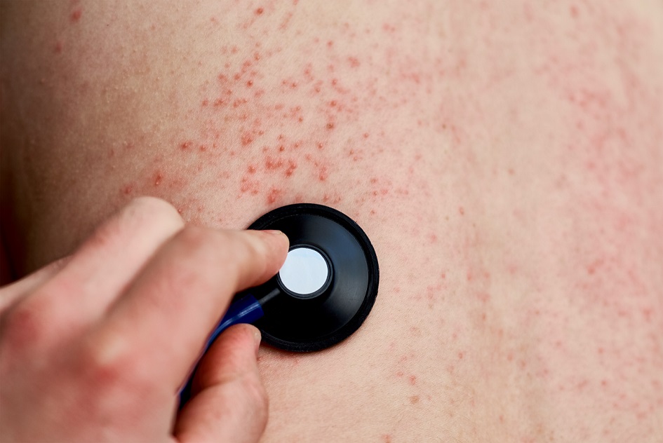 Dolor herpes